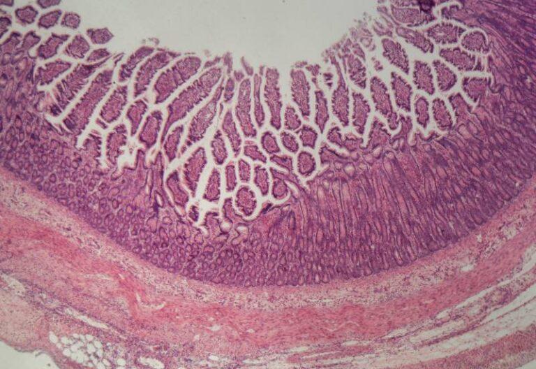View of Microscopic Colitis showing detailed layers and cellular structure in Atlanta, GA